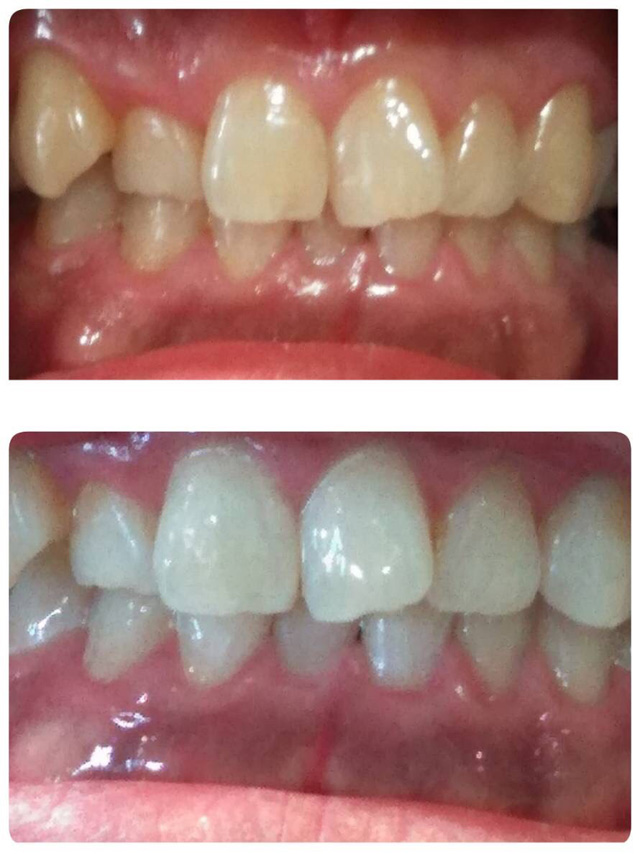 セルフホワイトニング